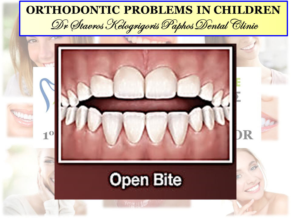 underbite